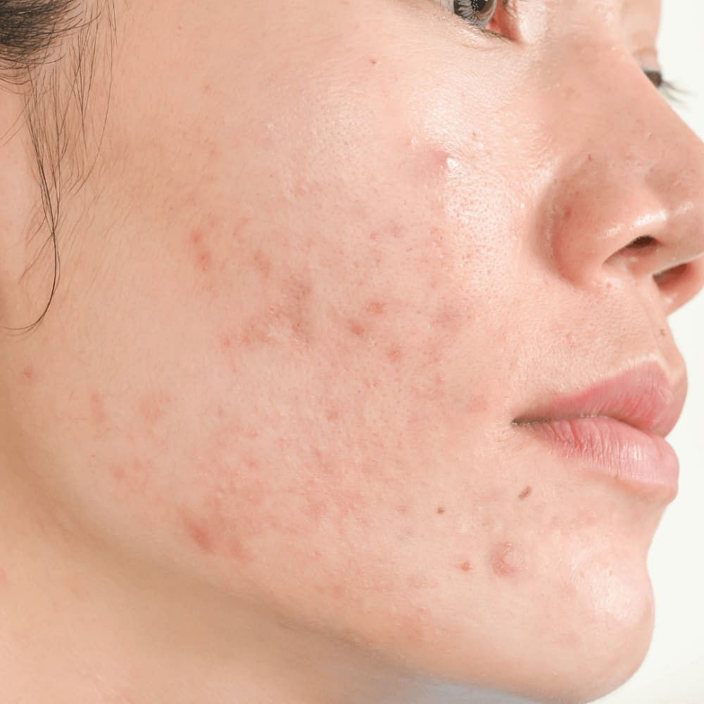 pcos-acne-pimple-causes-treatment-more-be-bodywise